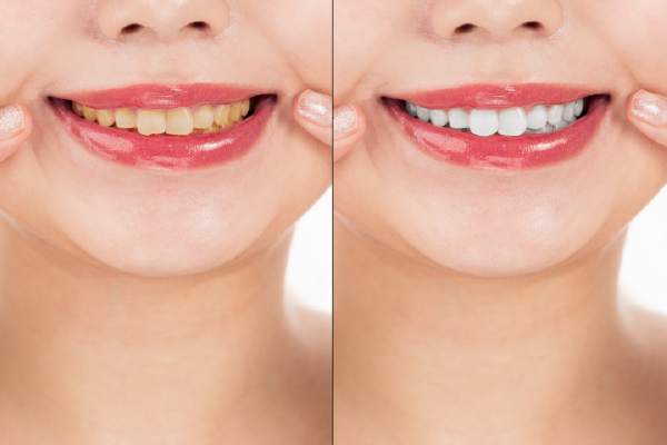 白い歯で自信を!